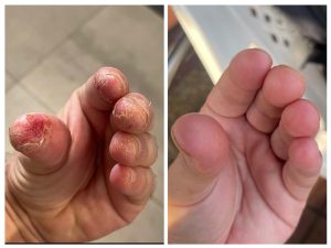 מארז לפסוריאזיס